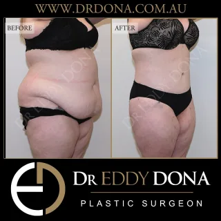 360 Tummy Tuck (Abdominoplasty)

The 360 Tummy Tuck (Abdominoplasty), is an operation that goes by many different names:

- Belt Lipectomy 
- Lower Body Lift 
- Total Body Lift
- Lower Truncoplasty 
- Buttock Lift combined with a Tummy Tuck

Experience & Excellence in Plastic Surgery is what you deserve

#DrEddyDona  #PlasticSurgeon #BraLipectomy  #FleurDeLis #OpenBook  #TummyTuck#Abdominoplasty #BeltLipectomy 

All surgery carries risks. You can learn more by visiting our website - link can be found in our bio. Or go to www.drdonaplasticsurgery.com.au/surgery-risks/ 
DISCLAIMER: All surgeries on this page are performed by Dr Eddy Dona and are published with the written consent by the patients.
After images are generally taken between 3-6 months post-surgery.
All surgery requires recovery time.
The outcomes shown are only relevant for this patient and do not necessarily reflect the results other patients may experience, even if they have a similar body type or shape. Results may vary due to many factors including an individual’s genetics and lifestyle.
The content on this page is general in nature and is not a substitute for a formal consultation. Before proceeding, please seek medical advice from an appropriately qualified medical practitioner. Dr Eddy Dona is a Specialist Plastic Surgeon (Registration: MED0001177175)