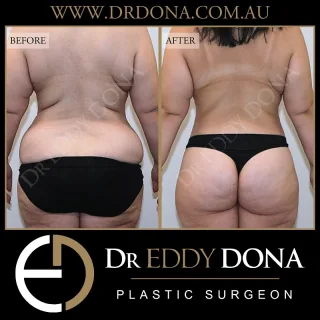 360 Tummy Tuck (Abdominoplasty)

The 360 Tummy Tuck (Abdominoplasty), is an operation that goes by many different names:

- Belt Lipectomy 
- Lower Body Lift 
- Total Body Lift
- Lower Truncoplasty 
- Buttock Lift combined with a Tummy Tuck

Experience & Excellence in Plastic Surgery is what you deserve

#DrEddyDona  #PlasticSurgeon #BraLipectomy  #FleurDeLis #OpenBook  #TummyTuck#Abdominoplasty #BeltLipectomy 

All surgery carries risks. You can learn more by visiting our website - link can be found in our bio. Or go to www.drdonaplasticsurgery.com.au/surgery-risks/ 
DISCLAIMER: All surgeries on this page are performed by Dr Eddy Dona and are published with the written consent by the patients.
After images are generally taken between 3-6 months post-surgery.
All surgery requires recovery time.
The outcomes shown are only relevant for this patient and do not necessarily reflect the results other patients may experience, even if they have a similar body type or shape. Results may vary due to many factors including an individual’s genetics and lifestyle.
The content on this page is general in nature and is not a substitute for a formal consultation. Before proceeding, please seek medical advice from an appropriately qualified medical practitioner. Dr Eddy Dona is a Specialist Plastic Surgeon (Registration: MED0001177175)