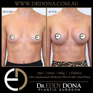 BREAST AUGMENTATION 

Experience & Excellence in Plastic Surgery is what you deserve.

#BreastImplants #DrEddyDona #PlasticSurgery #BreastAugmentation

All surgery carries risks. You can learn more by visiting our website - link can be found in our
bio.
Or go to http://www.drdonaplasticsurgery.com.au/surgery-risks/

DISCLAIMER: All surgeries on this page are performed by Dr Eddy Dona and are published with the written consent by the patients.
After images are generally taken between 3-6 months post-surgery.
All surgery requires recovery time.
The outcomes shown are only relevant for this patient and do not necessarily reflect the results other patients may experience, even if they have a similar body type or shape.
Results may vary due to many factors including an individual’s genetics and lifestyle.
The content on this page is general in nature and is not a substitute for a formal consultation.
Before proceeding, please seek medical advice from an appropriately qualified medical practitioner.
Dr Eddy Dona is a Specialist Plastic Surgeon
(Registration: MED0001177175)