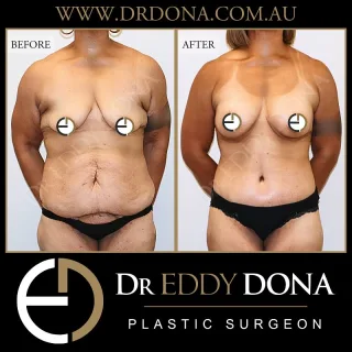 Belt Lipectomy (360 Tummy Tuck) + Breast Augmentation + Brachioplasty 

Experience & Excellence in Plastic Surgery is what you deserve.

#BreastAugmentation #DrEddyDona #PlasticSurgery #Abdominoplasty 

All surgery carries risks. You can learn more by visiting our website - link can be found in our
bio.
Or go to http://www.drdonaplasticsurgery.com.au/surgery-risks/

DISCLAIMER: All surgeries on this page are performed by Dr Eddy Dona and are published with the written consent by the patients.
After images are generally taken between 3-6 months post-surgery.
All surgery requires recovery time.
The outcomes shown are only relevant for this patient and do not necessarily reflect the results other patients may experience, even if they have a similar body type or shape.
Results may vary due to many factors including an individual’s genetics and lifestyle.
The content on this page is general in nature and is not a substitute for a formal consultation.
Before proceeding, please seek medical advice from an appropriately qualified medical practitioner.
Dr Eddy Dona is a Specialist Plastic Surgeon
(Registration: MED0001177175)